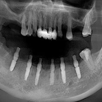下半口修復病例